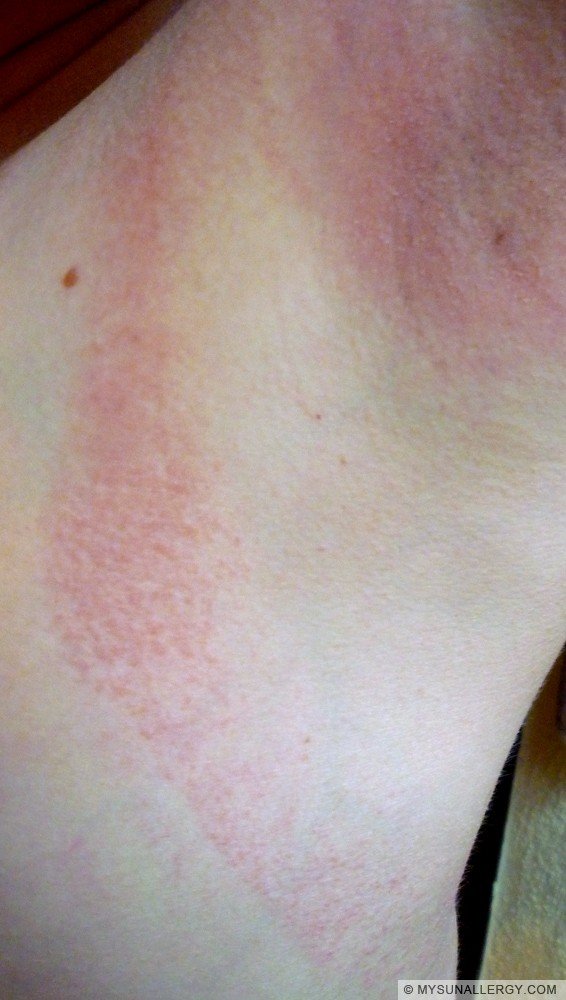 pinpoint red dots on skin after being in sun