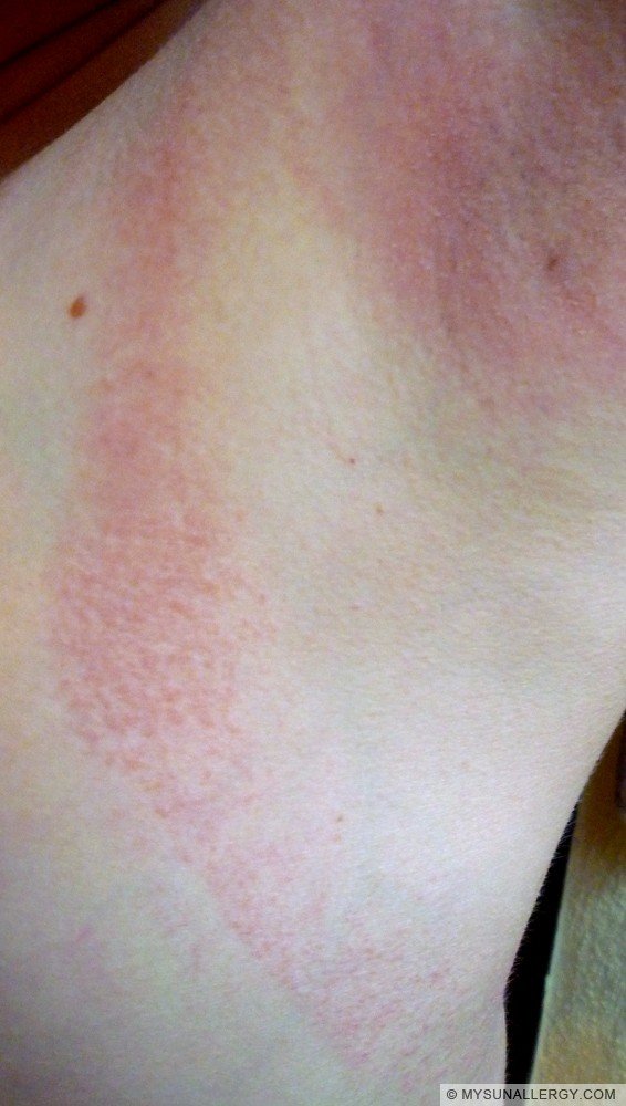 Polymorphous Light Eruption (PMLE) picture - under my arm