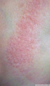 Polymorphous Light Eruption(PMLE) pictures and sun allergy rash images