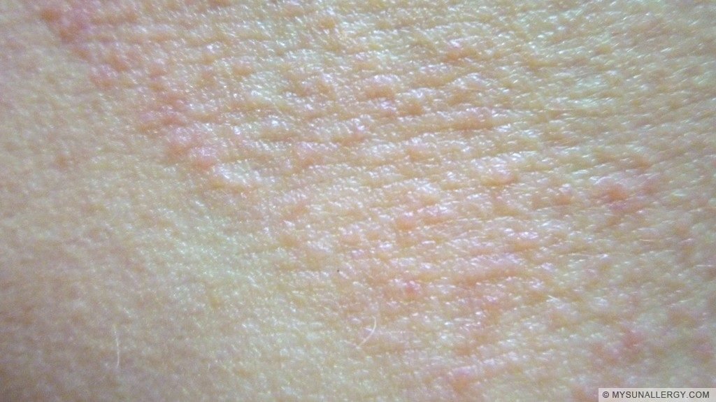 Polymorphous Light Eruption PMLE Pictures And Sun Allergy Rash Images