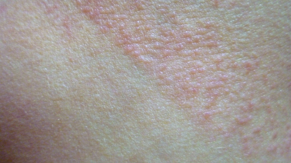 Polymorphous Light Eruption(PMLE) pictures and sun allergy rash images