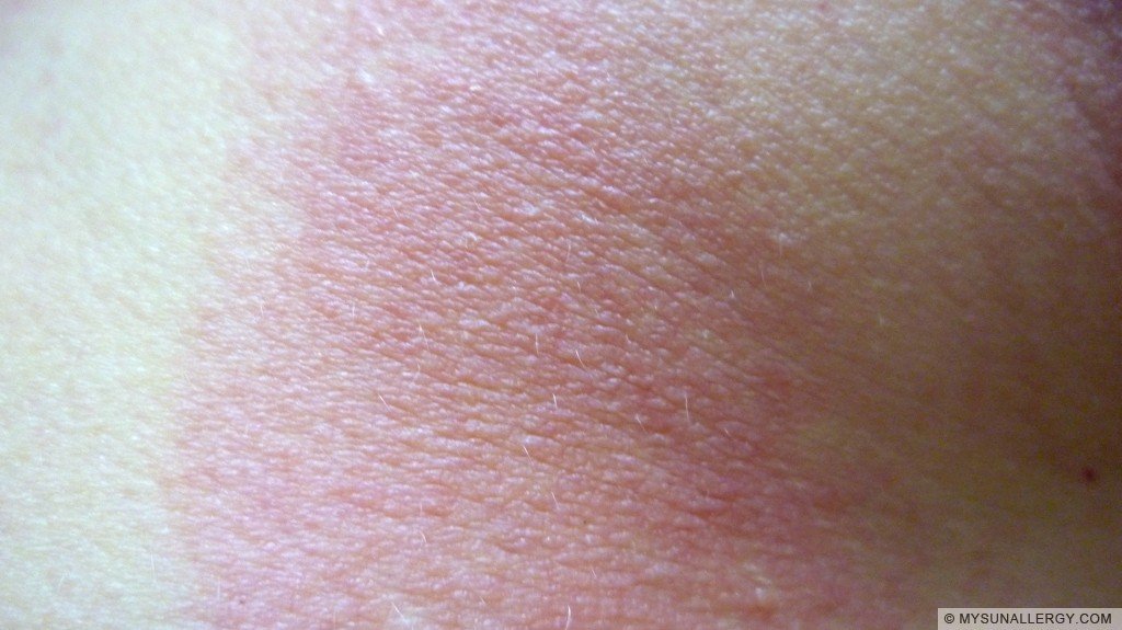 My PMLE rash on the 6th day of sun exposure. Itchy and dry!