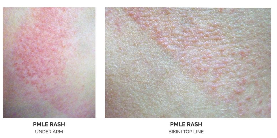 PMLE rash is the most common Sun Allergy rash